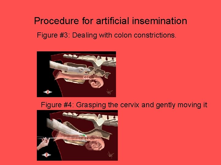 Procedure for artificial insemination Figure #3: Dealing with colon constrictions. Figure #4: Grasping the