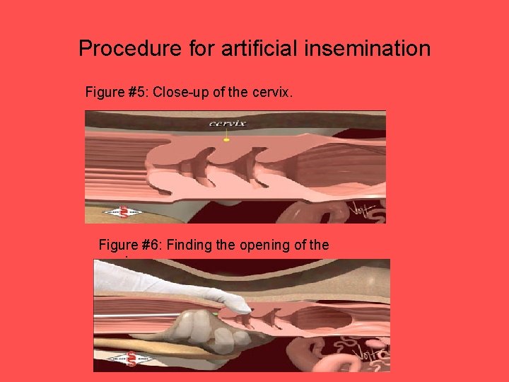 Procedure for artificial insemination Figure #5: Close-up of the cervix. Figure #6: Finding the