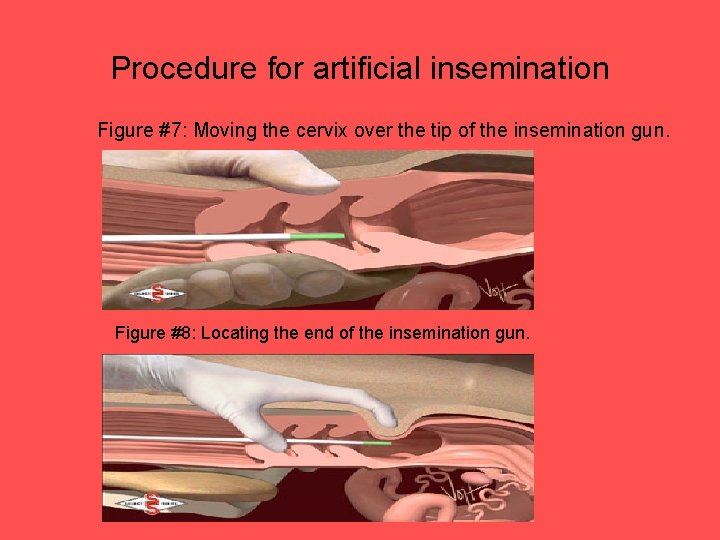 Procedure for artificial insemination Figure #7: Moving the cervix over the tip of the