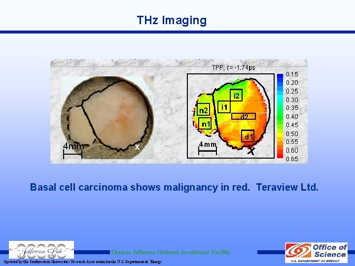 THz Imaging Basal cell carcinoma shows malignancy in red. Teraview Ltd. Thomas Jefferson National