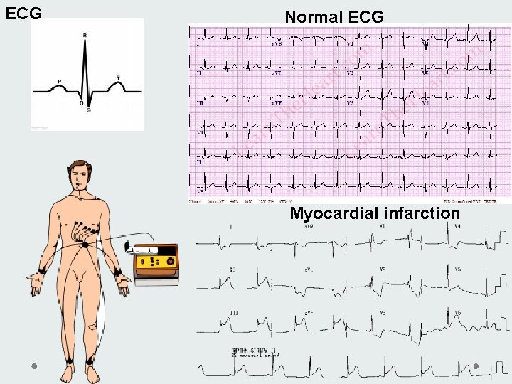 ECG Normal ECG Myocardial infarction 