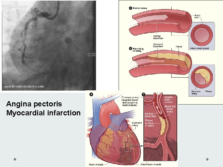 Angina pectoris Myocardial infarction Angina pectoris Myocardial infarction