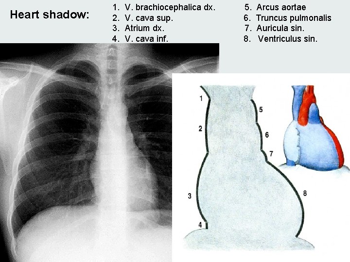 Heart shadow: 1. 2. 3. 4. V. brachiocephalica dx. V. cava sup. Atrium dx. Heart shadow: 1. 2. 3. 4. V. brachiocephalica dx. V. cava sup. Atrium dx.