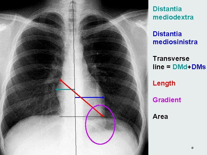 Distantia mediodextra Distantia mediosinistra Transverse line = DMd+DMs Length Gradient Area Distantia mediodextra Distantia mediosinistra Transverse line = DMd+DMs Length Gradient Area