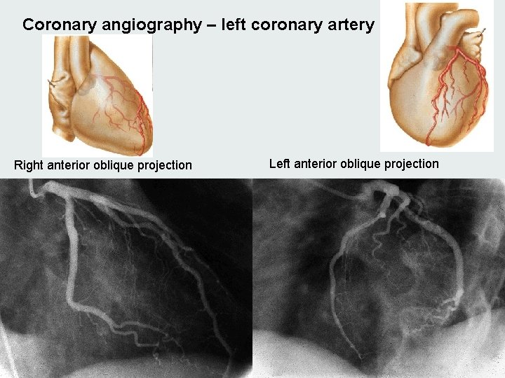 Coronary angiography – left coronary artery Right anterior oblique projection Left anterior oblique projection Coronary angiography – left coronary artery Right anterior oblique projection Left anterior oblique projection