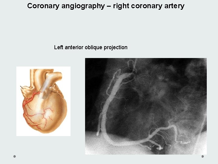 Coronary angiography – right coronary artery Left anterior oblique projection Coronary angiography – right coronary artery Left anterior oblique projection