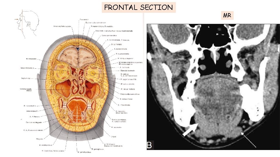FRONTAL SECTION MR FRONTAL SECTION MR