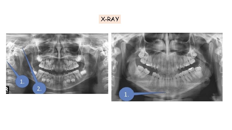 X-RAY X-RAY