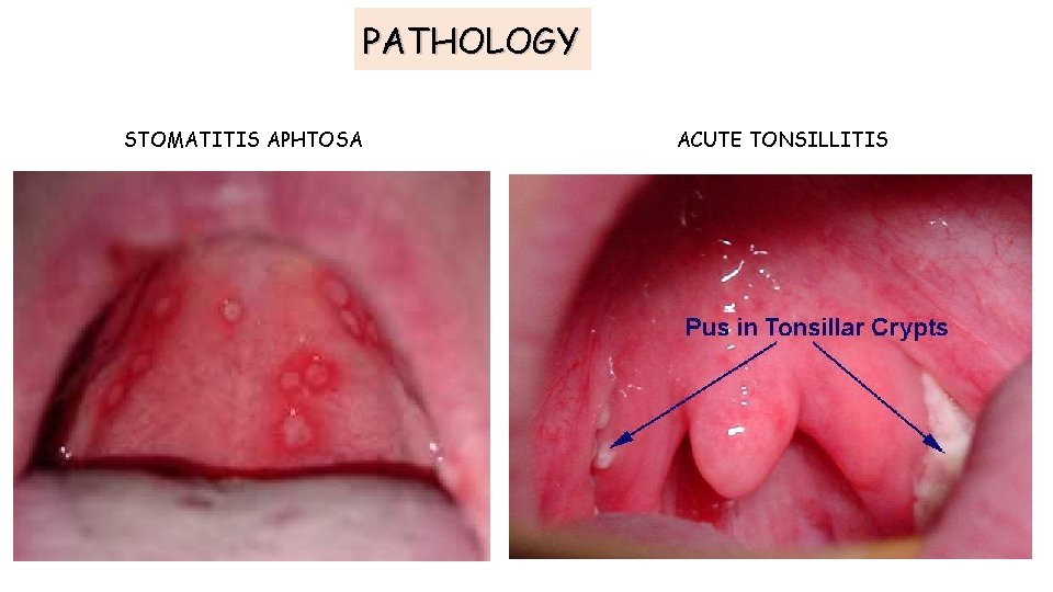 PATHOLOGY STOMATITIS APHTOSA ACUTE TONSILLITIS PATHOLOGY STOMATITIS APHTOSA ACUTE TONSILLITIS