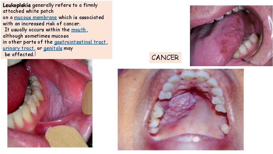 Leukoplakia generally refers to a firmly attached white patch on a mucous membrane which Leukoplakia generally refers to a firmly attached white patch on a mucous membrane which