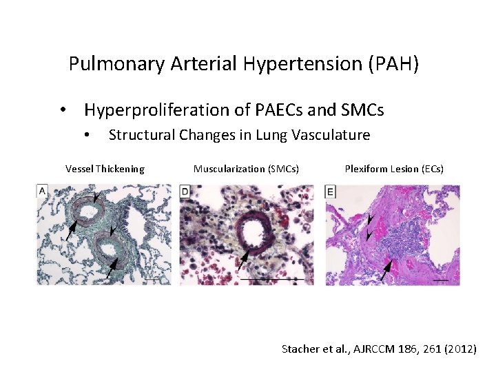 Pulmonary Arterial Hypertension (PAH) • Hyperproliferation of PAECs and SMCs • Structural Changes in