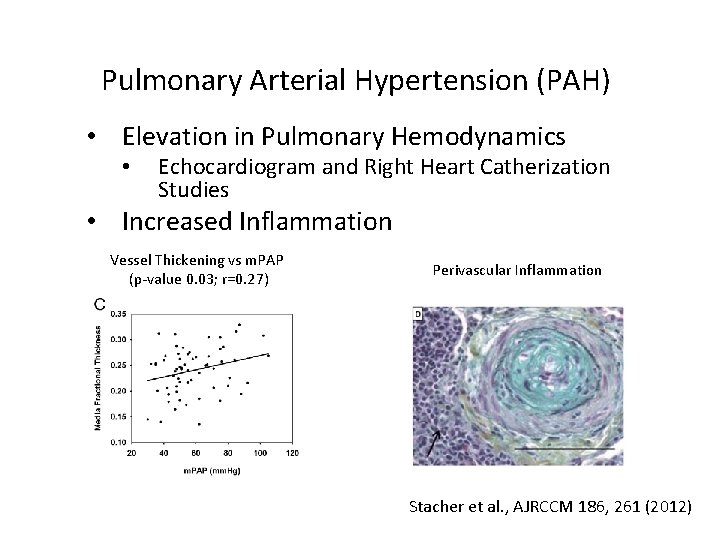 Pulmonary Arterial Hypertension (PAH) • Elevation in Pulmonary Hemodynamics • Echocardiogram and Right Heart