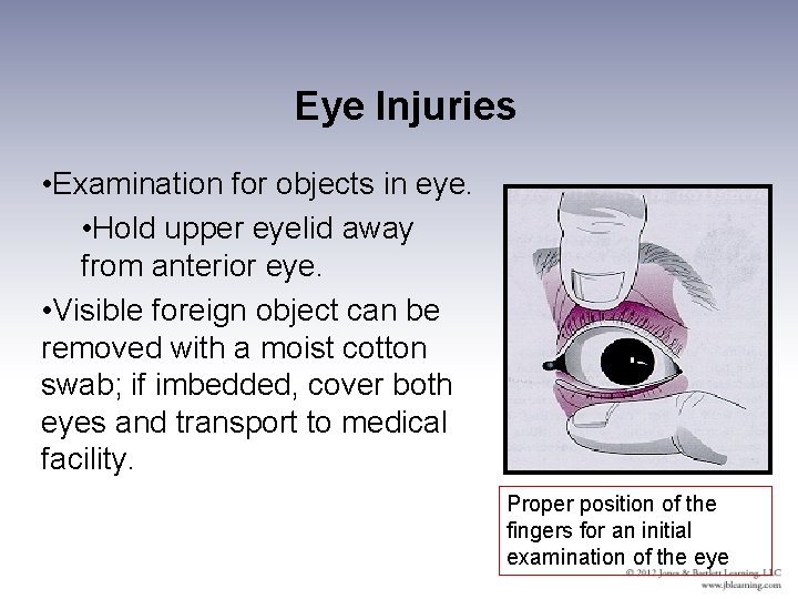 Eye Injuries • Examination for objects in eye. • Hold upper eyelid away from