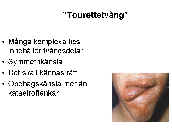 ”Tourettetvång” • Många komplexa tics innehåller tvångsdelar • Symmetrikänsla • Det skall kännas rätt