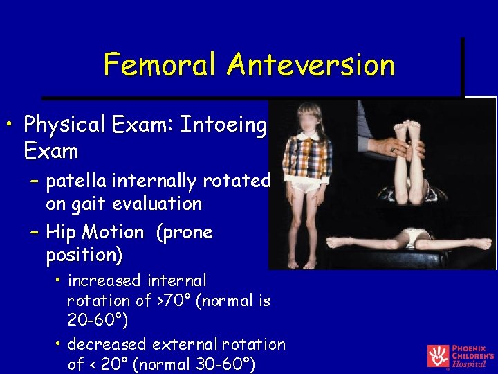 Femoral Anteversion • Physical Exam: Intoeing Exam – patella internally rotated on gait evaluation Femoral Anteversion • Physical Exam: Intoeing Exam – patella internally rotated on gait evaluation