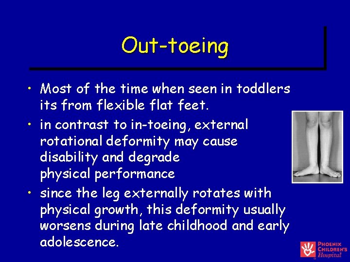 Out-toeing • Most of the time when seen in toddlers its from flexible flat Out-toeing • Most of the time when seen in toddlers its from flexible flat