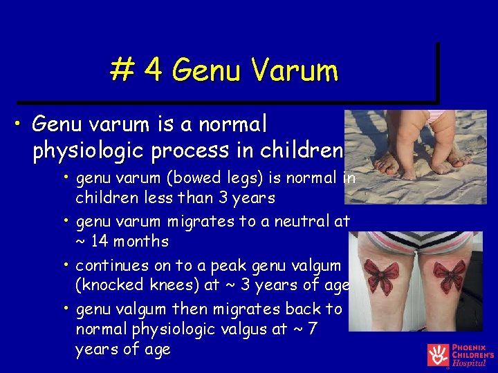 # 4 Genu Varum • Genu varum is a normal physiologic process in children # 4 Genu Varum • Genu varum is a normal physiologic process in children