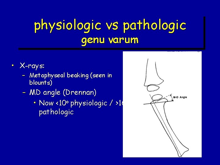 physiologic vs pathologic genu varum • X-rays: – Metaphyseal beaking (seen in blounts) – physiologic vs pathologic genu varum • X-rays: – Metaphyseal beaking (seen in blounts) –