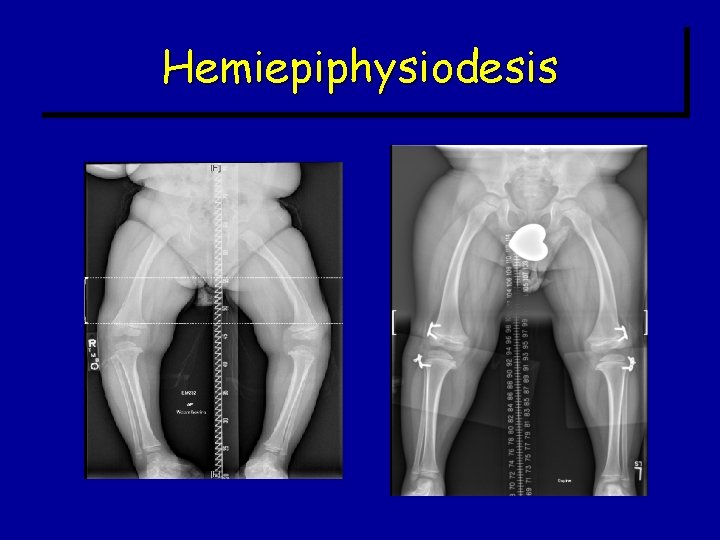 Hemiepiphysiodesis Hemiepiphysiodesis