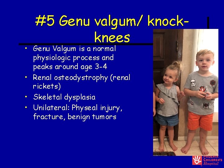 #5 Genu valgum/ knockknees • Genu Valgum is a normal physiologic process and peaks #5 Genu valgum/ knockknees • Genu Valgum is a normal physiologic process and peaks