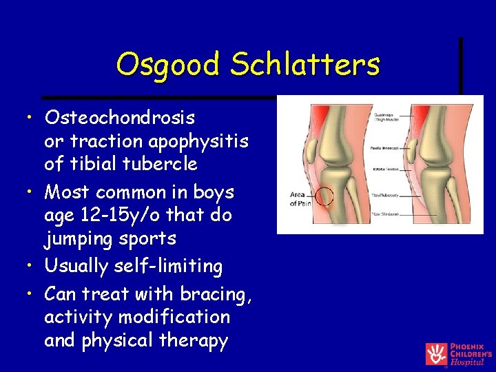 Osgood Schlatters • Osteochondrosis or traction apophysitis of tibial tubercle • Most common in Osgood Schlatters • Osteochondrosis or traction apophysitis of tibial tubercle • Most common in