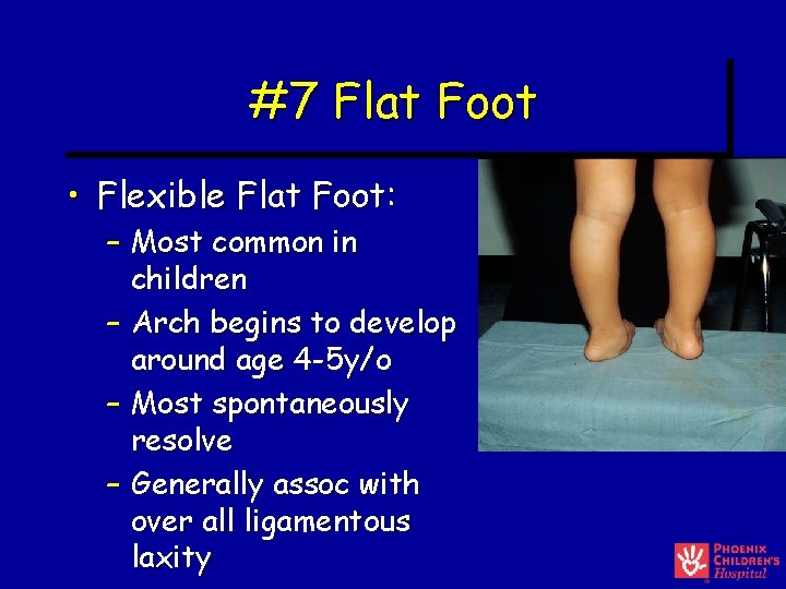 #7 Flat Foot • Flexible Flat Foot: – Most common in children – Arch #7 Flat Foot • Flexible Flat Foot: – Most common in children – Arch