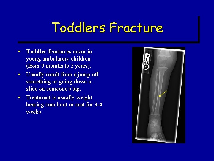 Toddlers Fracture • Toddler fractures occur in young ambulatory children (from 9 months to Toddlers Fracture • Toddler fractures occur in young ambulatory children (from 9 months to