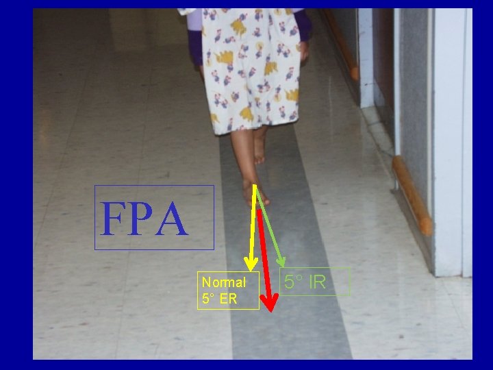 FPA Normal 5° ER 5° IR FPA Normal 5° ER 5° IR