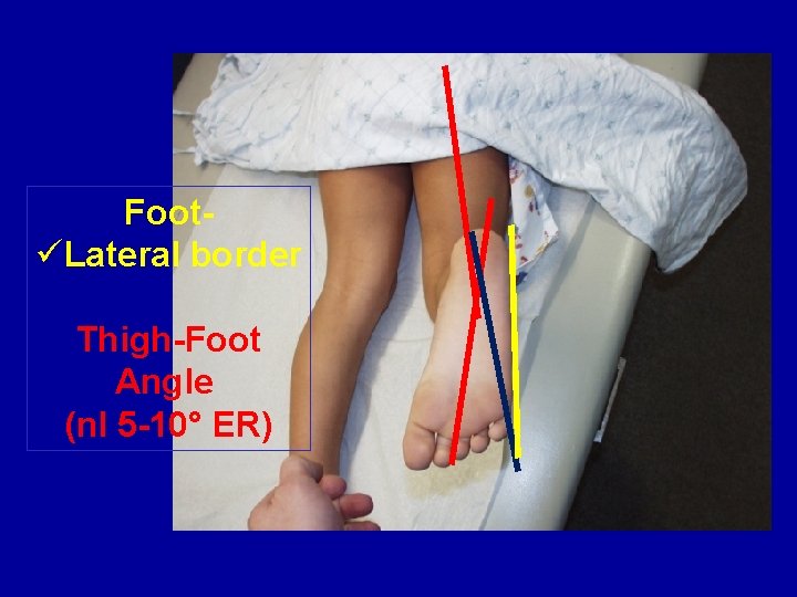 FootüLateral border Thigh-Foot Angle (nl 5 -10° ER) FootüLateral border Thigh-Foot Angle (nl 5 -10° ER)
