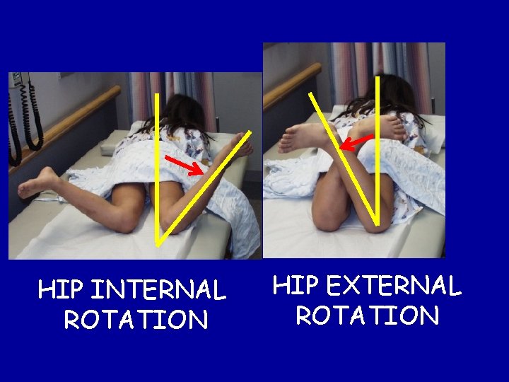 HIP INTERNAL ROTATION HIP EXTERNAL ROTATION HIP INTERNAL ROTATION HIP EXTERNAL ROTATION