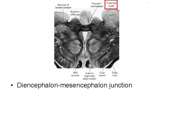  • Diencephalon-mesencephalon junction 