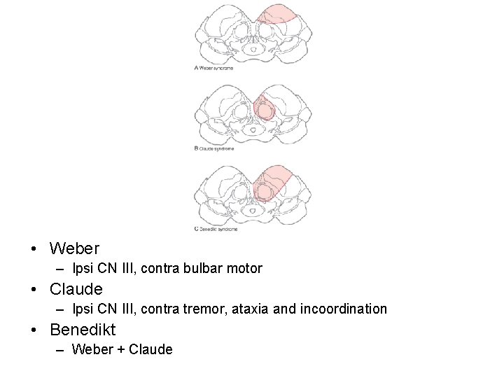  • Weber – Ipsi CN III, contra bulbar motor • Claude – Ipsi