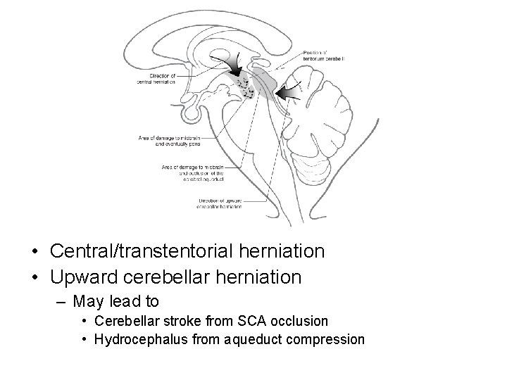  • Central/transtentorial herniation • Upward cerebellar herniation – May lead to • Cerebellar