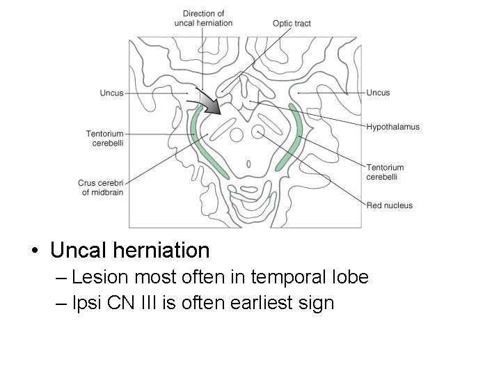  • Uncal herniation – Lesion most often in temporal lobe – Ipsi CN