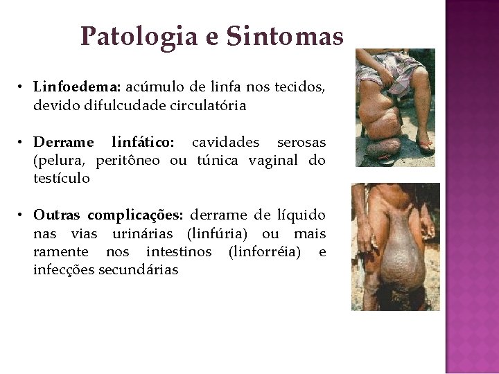 Patologia e Sintomas • Linfoedema: acúmulo de linfa nos tecidos, devido difulcudade circulatória •