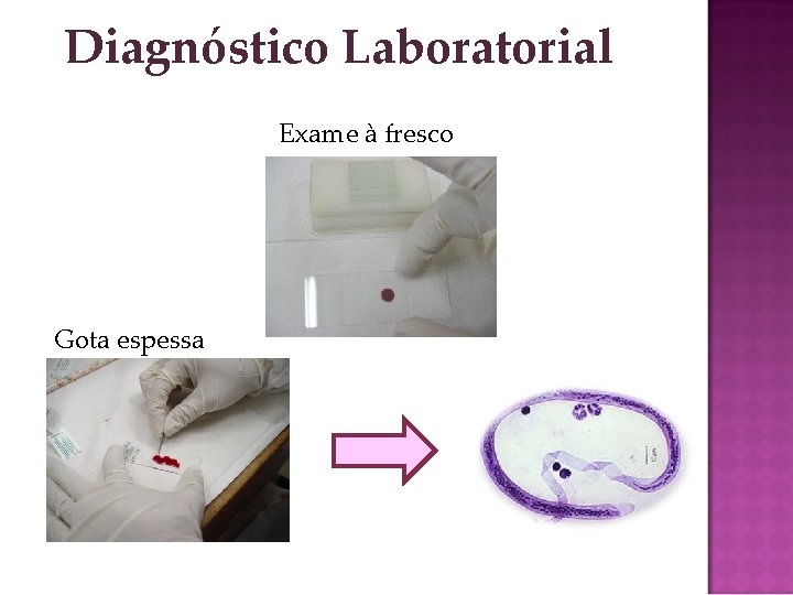 Diagnóstico Laboratorial Exame à fresco Gota espessa 