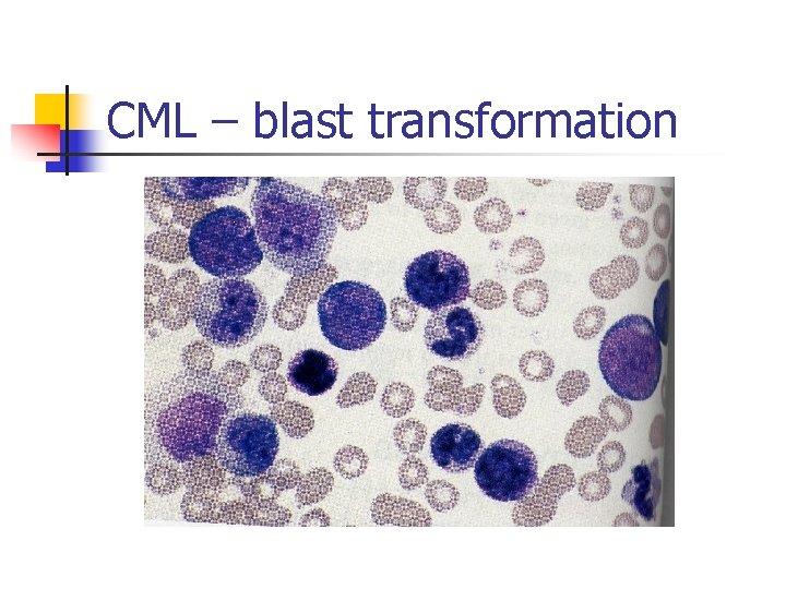 CML – blast transformation 