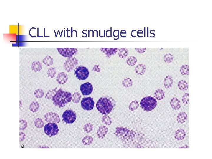 CLL with smudge cells 