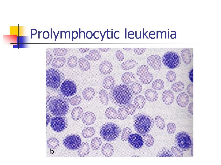 Prolymphocytic leukemia 