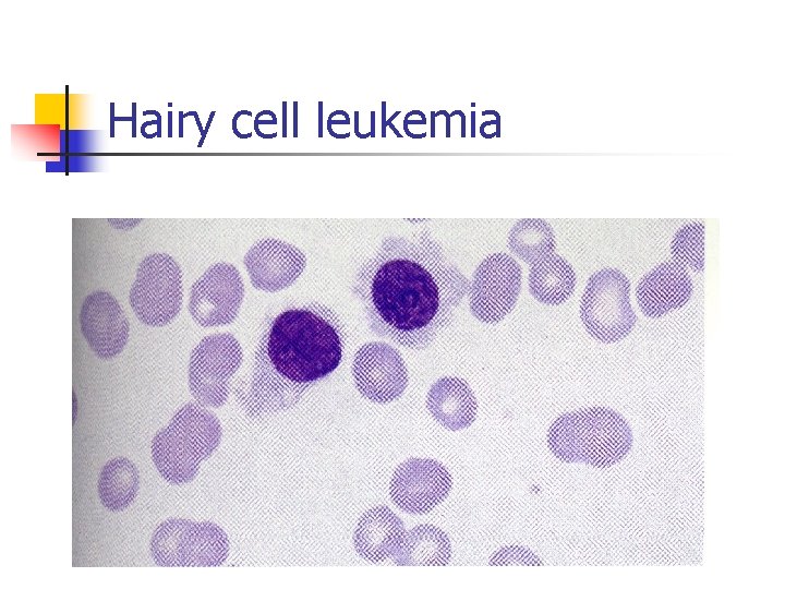 Hairy cell leukemia 