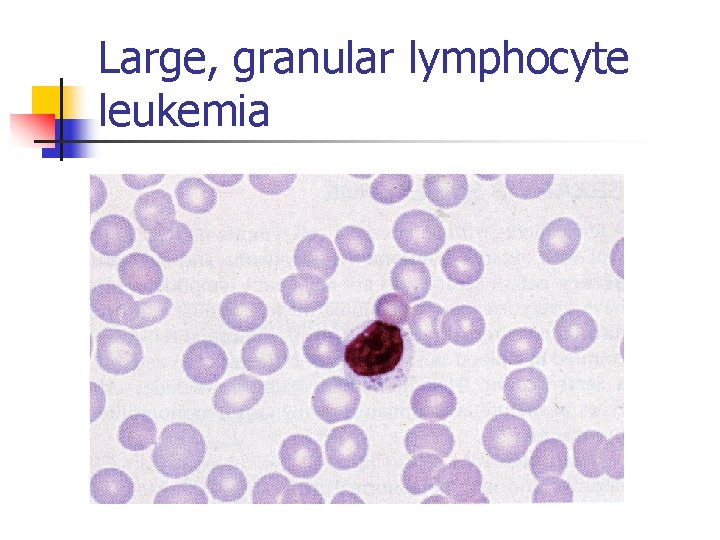 Large, granular lymphocyte leukemia 