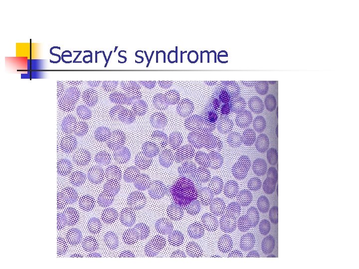 Sezary’s syndrome 