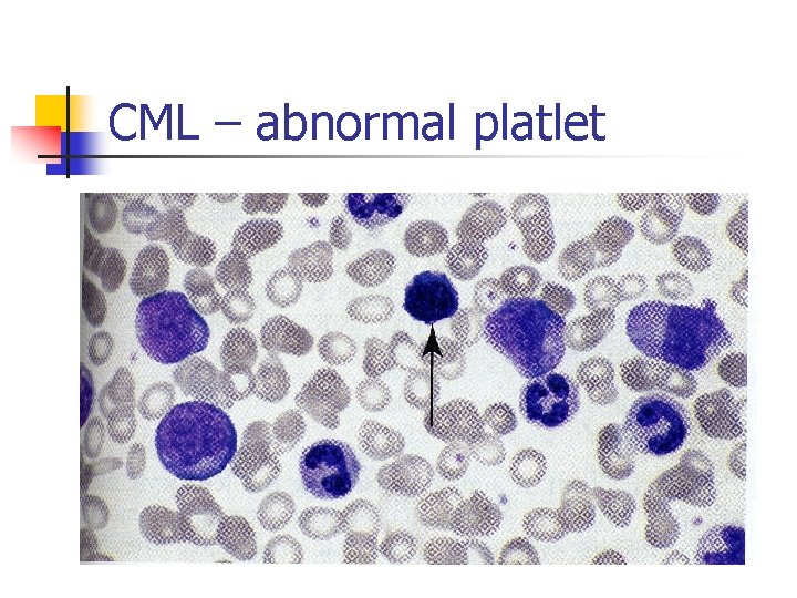 CML – abnormal platlet 