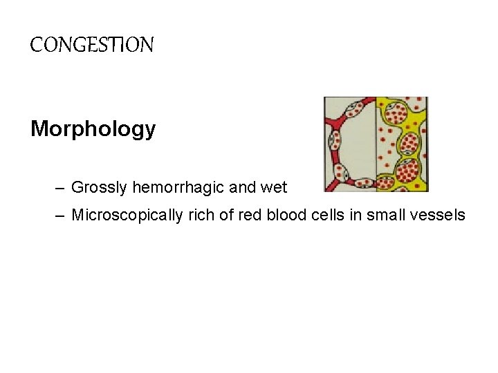 CONGESTION Morphology – Grossly hemorrhagic and wet – Microscopically rich of red blood cells