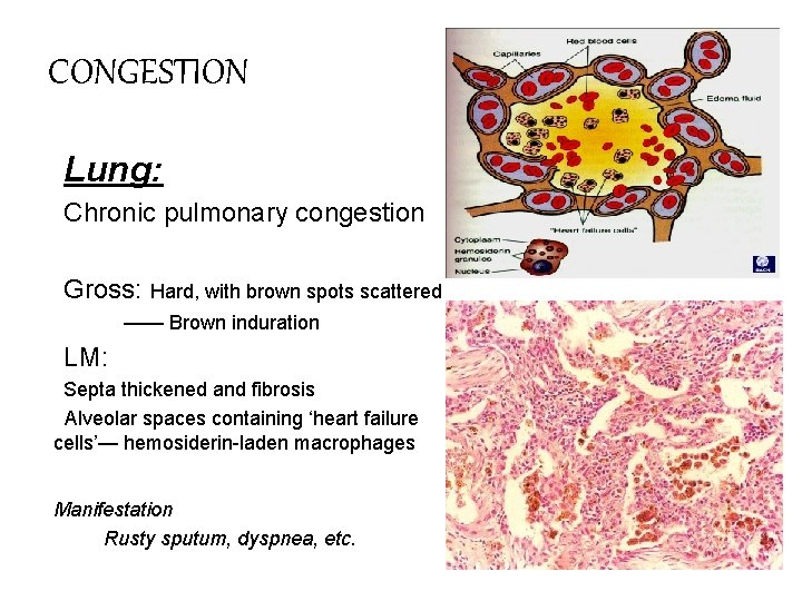 CONGESTION Lung: Chronic pulmonary congestion Gross: Hard, with brown spots scattered —— Brown induration