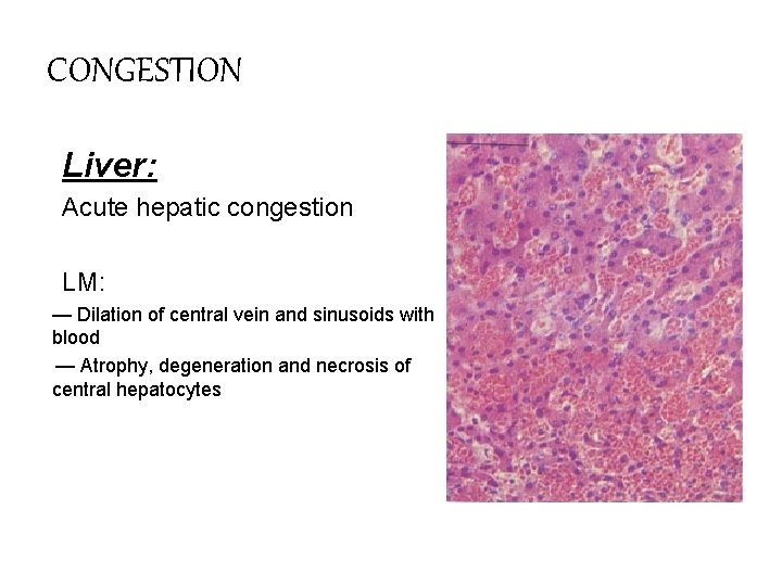 CONGESTION Liver: Acute hepatic congestion LM: — Dilation of central vein and sinusoids with