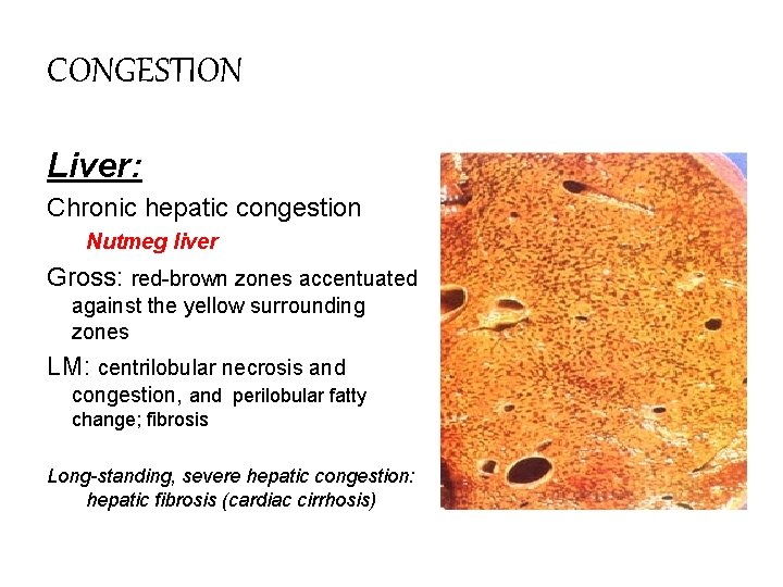 CONGESTION Liver: Chronic hepatic congestion Nutmeg liver Gross: red-brown zones accentuated against the yellow