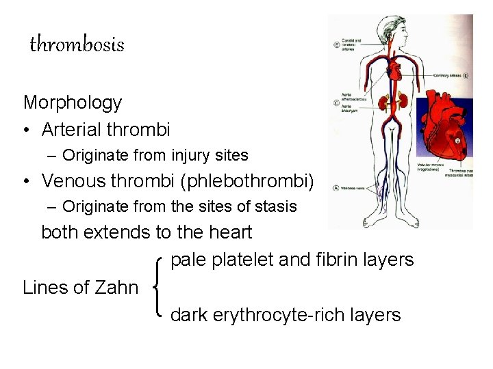 thrombosis Morphology • Arterial thrombi – Originate from injury sites • Venous thrombi (phlebothrombi)