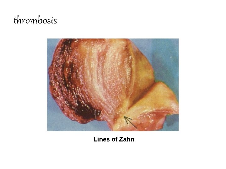 thrombosis Lines of Zahn 