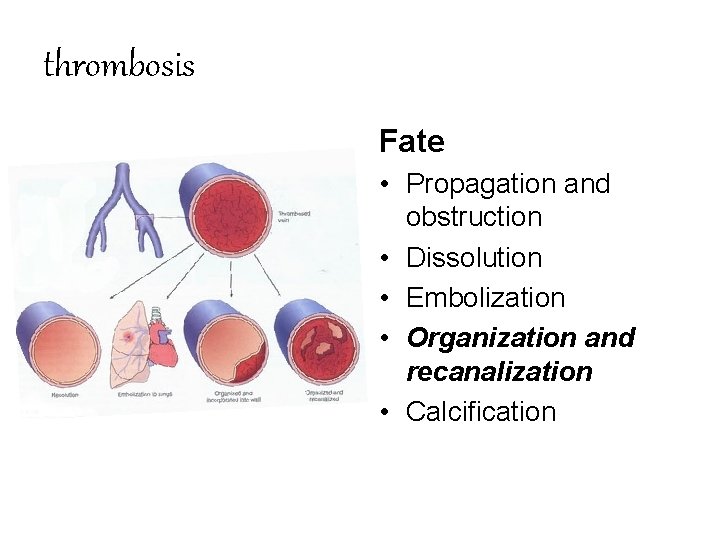 thrombosis Fate • Propagation and obstruction • Dissolution • Embolization • Organization and recanalization